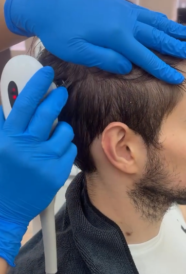 Foto de peluquería - Radiofrecuencia capilar